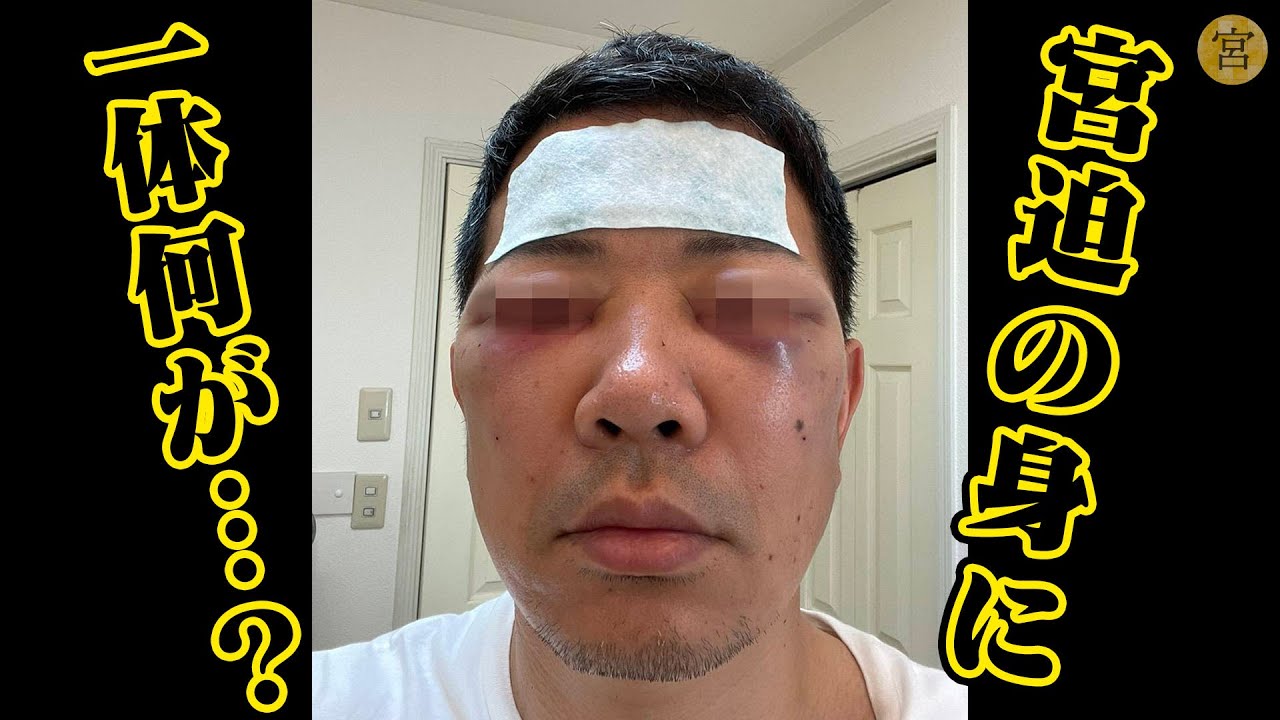 宮迫博之が整形手術、YouTubeで報告